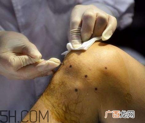关节炎积液什么症状？关节炎积水怎么治疗？