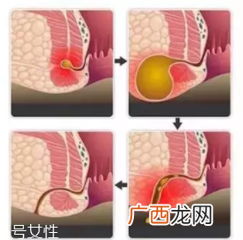 肛瘘非手术治疗才可以吗？手术是治疗的关键途径