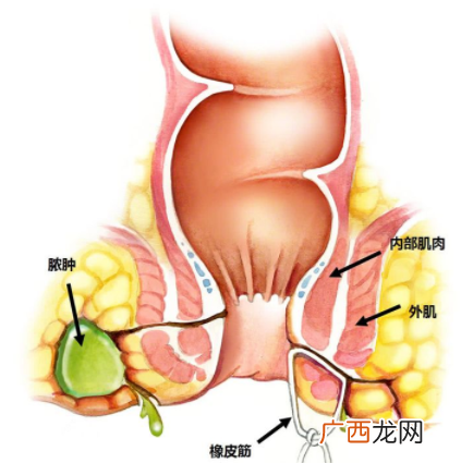 肛瘘非手术治疗才可以吗？手术是治疗的关键途径