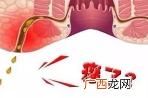 肛瘘非手术治疗才可以吗？手术是治疗的关键途径