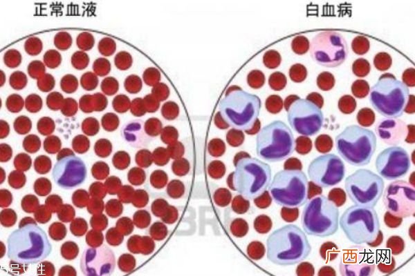 什么是白血病患白血病的症状有什么