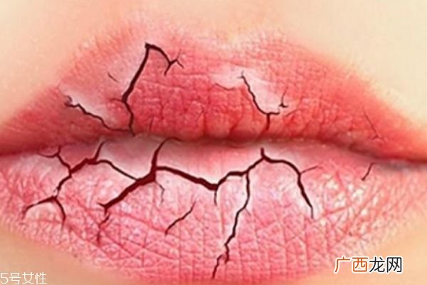 夏天为什么容易嘴巴起皮呢如何治疗嘴巴起皮呢