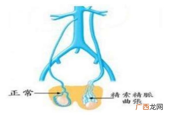 什么是经脉曲张将脉曲张的危害是什么
