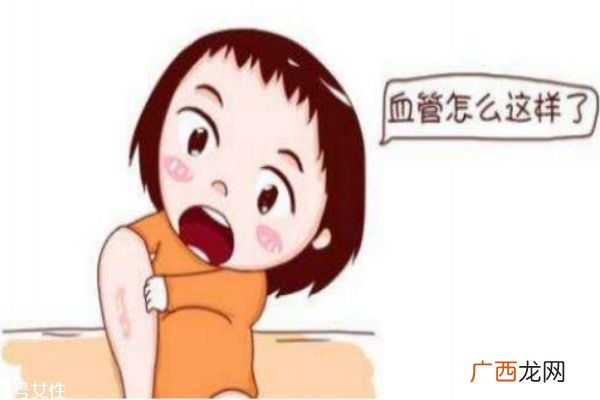 什么是经脉曲张将脉曲张的危害是什么