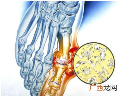 痛风可以治愈吗？无法治愈但能控制