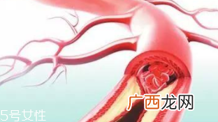 血管堵塞怎么自查？腿脚告诉你答案