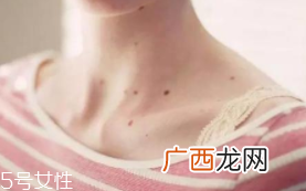 色素痣是肿瘤吗？良性肿瘤不必担心