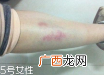 身体淤青怎么来的?不是磕碰那么简单
