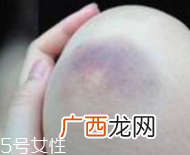 身体淤青怎么来的?不是磕碰那么简单