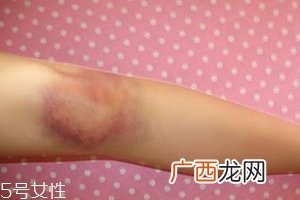 身体淤青怎么来的?不是磕碰那么简单
