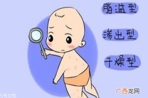 婴儿干性湿疹怎办教你如何区分湿疹