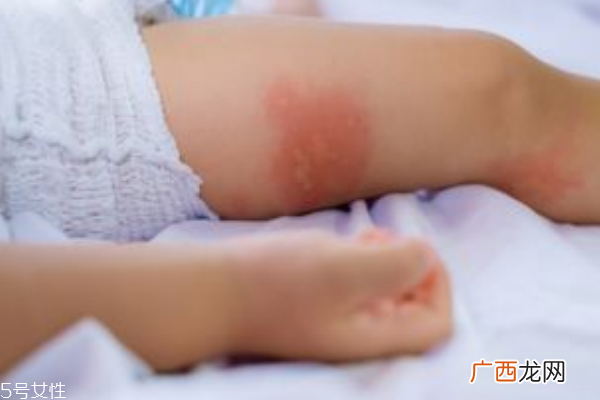 宝宝湿疹是怎么引起的正确护理宝宝的方式