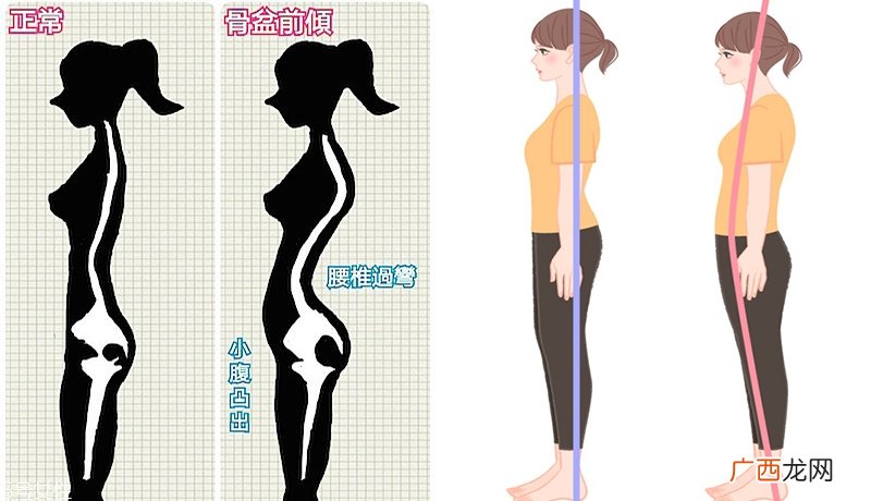 骨盆前倾如何矫正骨盆前倾矫正动作图解