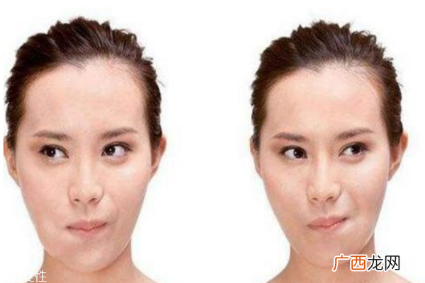 口角炎吃什么口角炎原因