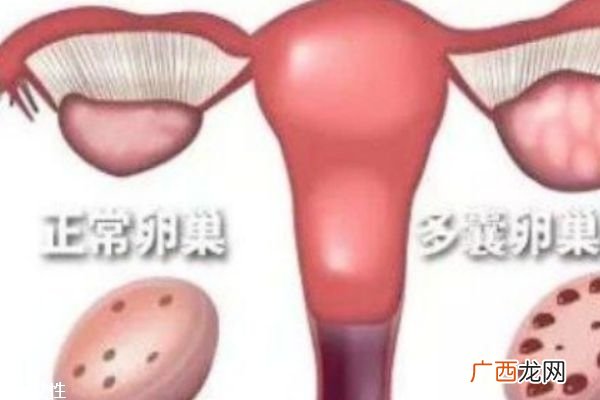多囊卵巢综合症是什么可以治愈吗