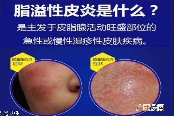 脂溢性皮炎症状怎么预防