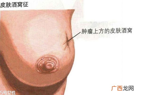 乳腺癌的早期症状带你认识乳腺癌