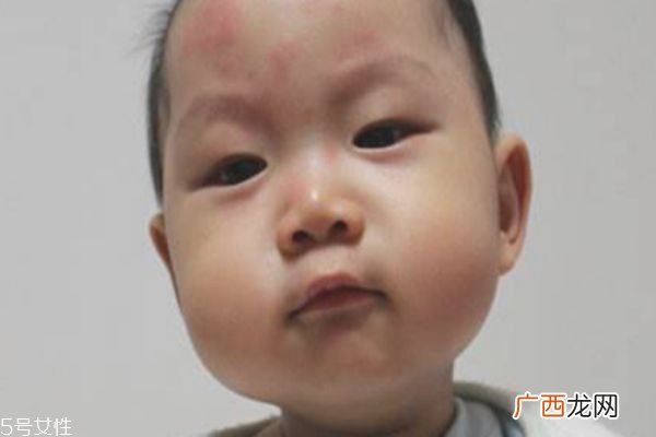 幼儿急疹和感冒发烧的区别幼儿急疹的临床症状