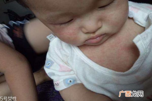 幼儿急疹和感冒发烧的区别幼儿急疹的临床症状