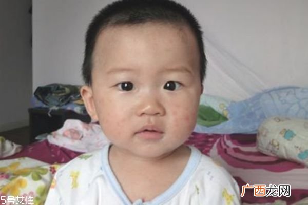 幼儿急疹发烧怎么办幼儿急疹典型的特点