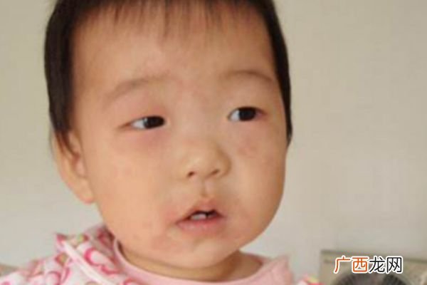 幼儿急疹的症状及治疗家长们要注意