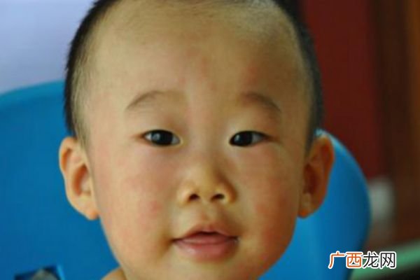 幼儿急疹的症状及治疗家长们要注意
