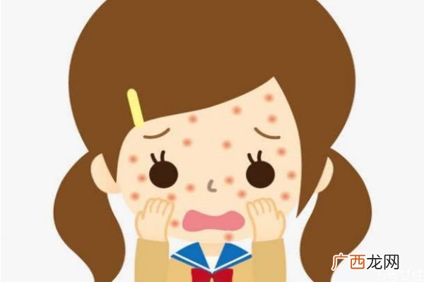 麻疹是怎么样传播的呢麻疹的易感染人群是哪些呢