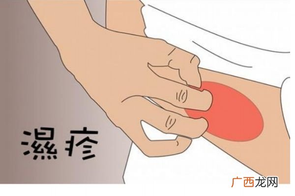 湿疹的症状有什么呢湿疹造成的原因有什么呢