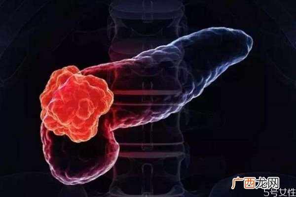 什么是胰腺癌呢胰腺癌有什么危害呢