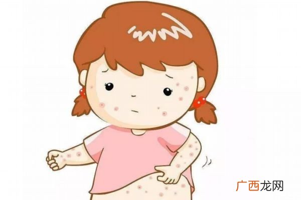 痱子是怎么造成的呢为什么会有痱子呢