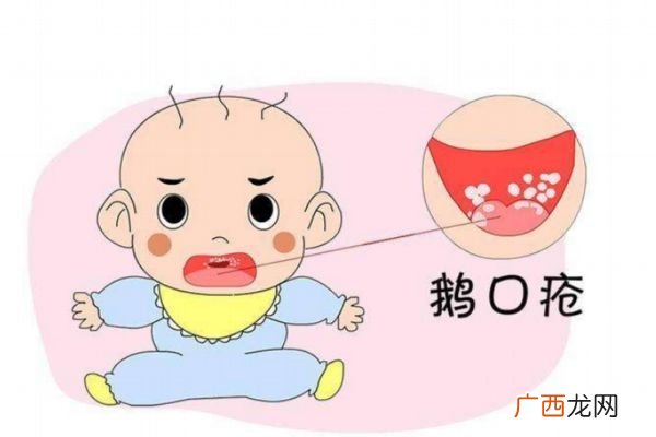 什么是鹅口疮鹅口疮危害大吗