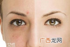 祛痘产品怎么选？先要分清痘印类型