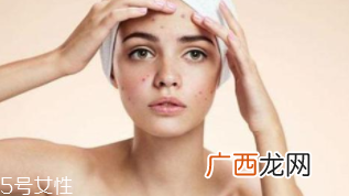 祛痘产品怎么选？先要分清痘印类型