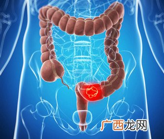 吃早餐可以预防胆结石形成的原因