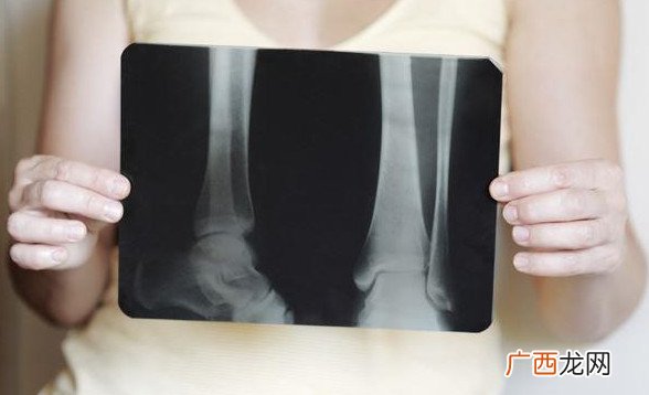 补钙要注意什么不补镁易得肾结石