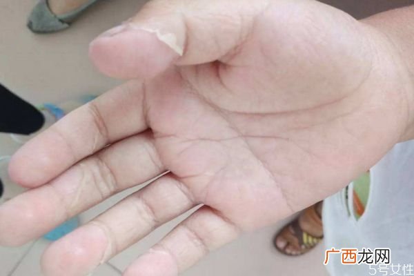 什么是猩红热呢猩红热有什么症状呢