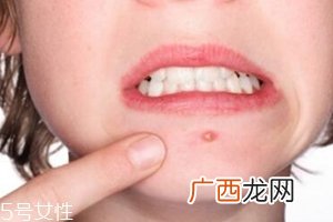 肌肤需要排毒吗？长痘并不代表排毒