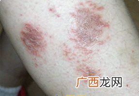 冬季小腿特别痒是怎么回事