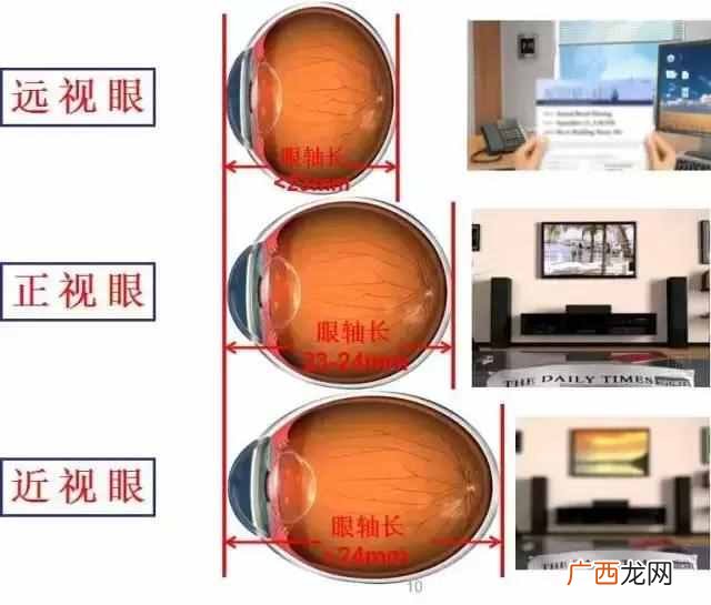 近视眼可以分为哪几类 什么是指数近视