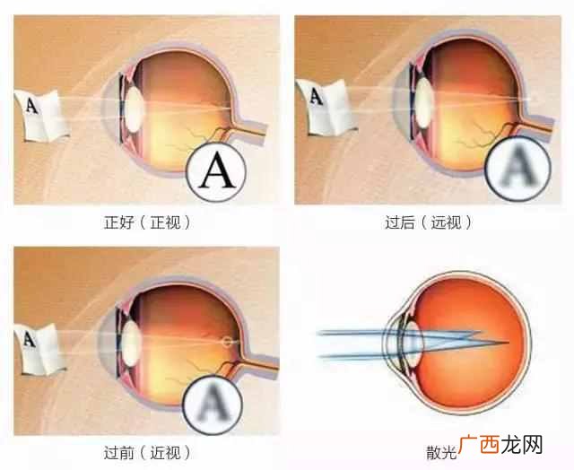 近视眼可以分为哪几类 什么是指数近视