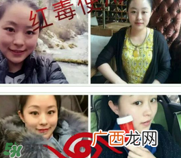 美国红毒溶脂怎么样？美国红毒溶脂有用吗？