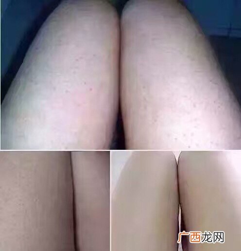 小林去鸡皮膏有用吗小林去鸡皮膏好用吗