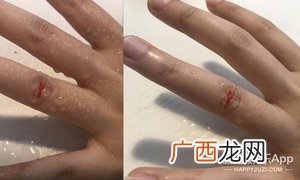 液体创可贴防水吗?液体创可贴防水吗透气吗?