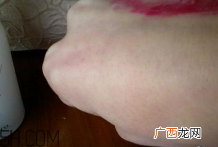芭妮兰卸妆膏用了长闭口怎么办？芭妮兰卸妆膏孕妇可以用吗？