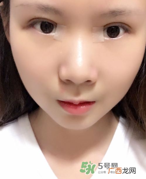 美皮护去疤效果怎么样？美皮护有用吗？