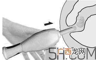 开塞露怎么用？开塞露用后多久会排便？