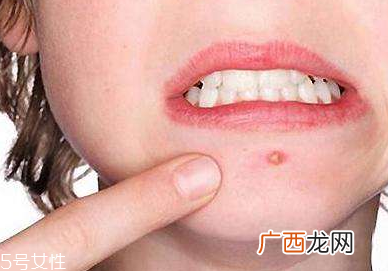 下巴起痘怎么办？超好用祛痘办法分享