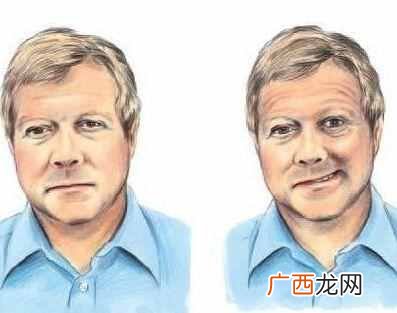 面瘫什么症状 什么叫面瘫