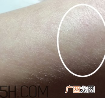 水杨酸可以去黑头吗？水杨酸可以去闭口吗