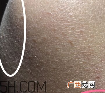 水杨酸可以去黑头吗？水杨酸可以去闭口吗